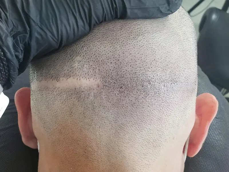 hajtetoválás hegeltávolítás